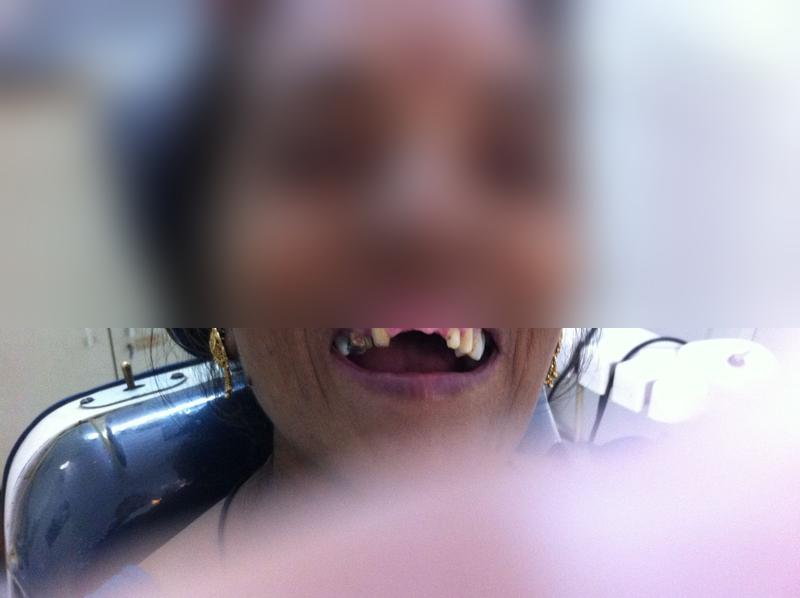 Full Mouth Denture β Before