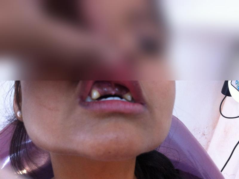 Anterior Teeth Replacement β Before