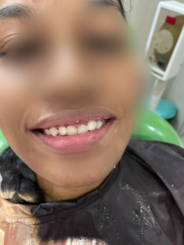 Root Canal + Crown β After