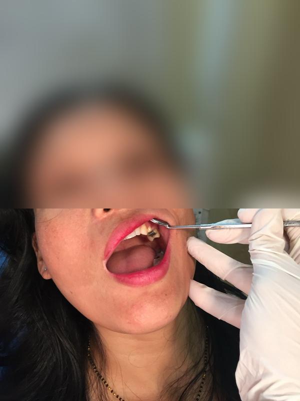 RCT + Zirconia Crown β Before
