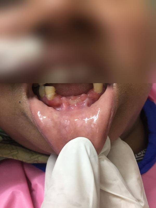 Crown Restoration β Before