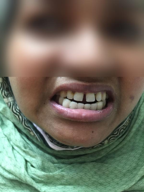 Crown Restoration β After